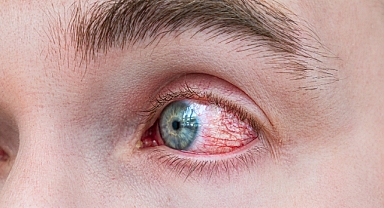 Göz alerjisi görme kaybına sebep olabilir!