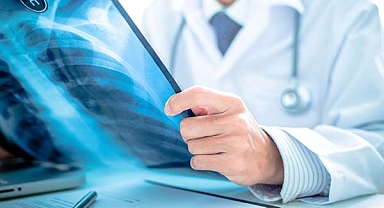 Akciğer röntgeni ciğerlerin yalnızca %70’ini gösteriyor