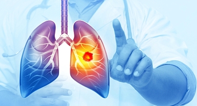 Her yıl 25 bin akciğer kanseri vakası önlenebilir